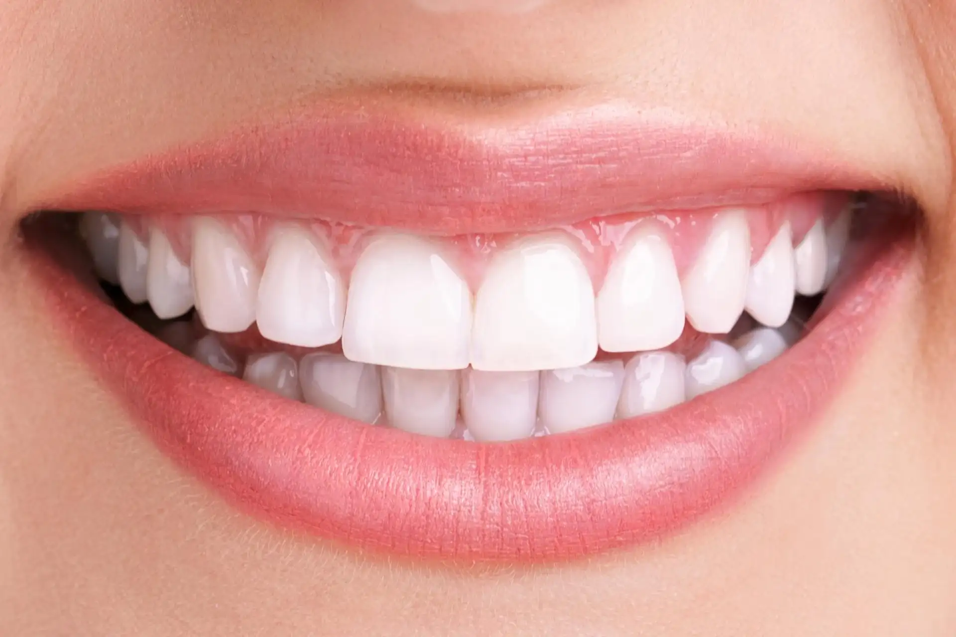 dentalpark samsun diş beyazlatma sonrası