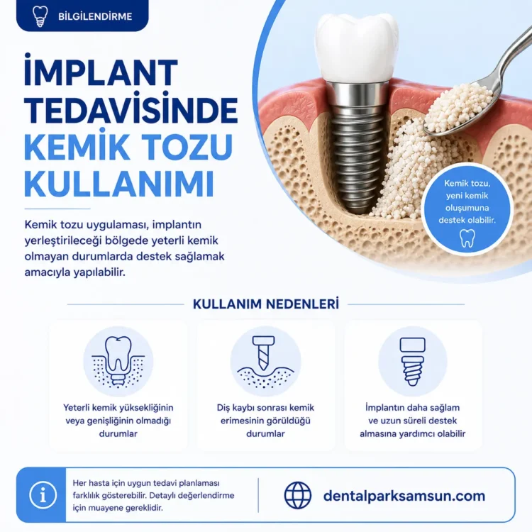 Samsun imlant tedavisinde kemik tozu kullanımı bilgilendirmesi