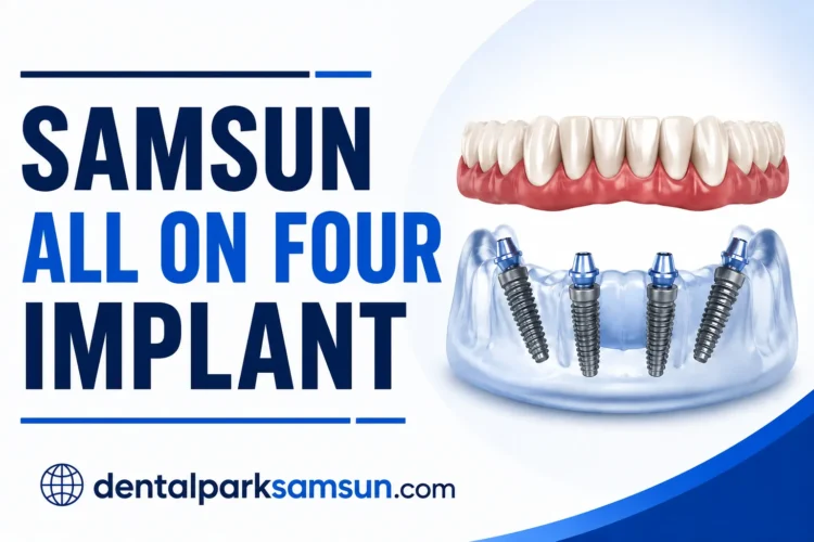 samsun all on 4 implant