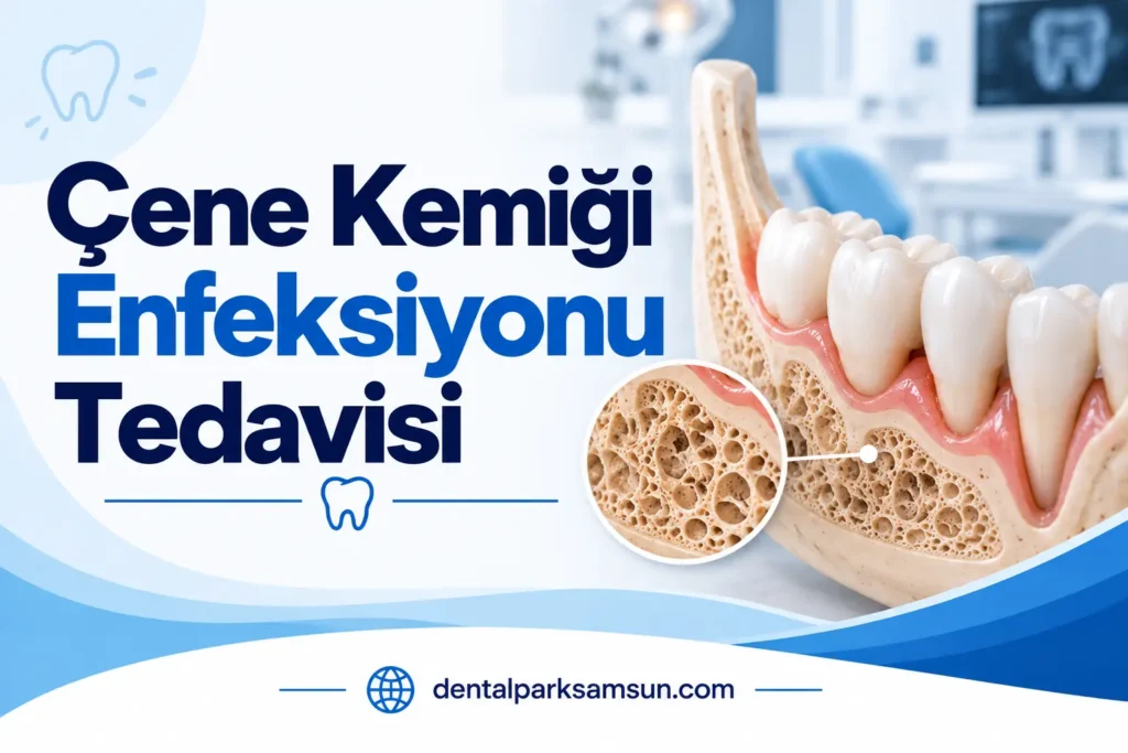 çene kemiği enfeksiyonu tedavisi için bilgilendirme