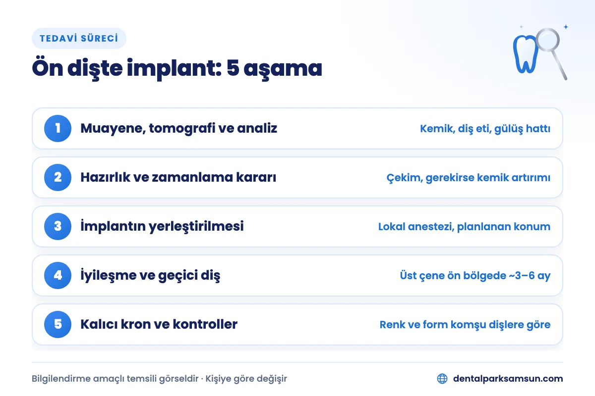 Samsun ön dişte implant süreci: muayeneden kalıcı krona 5 aşama