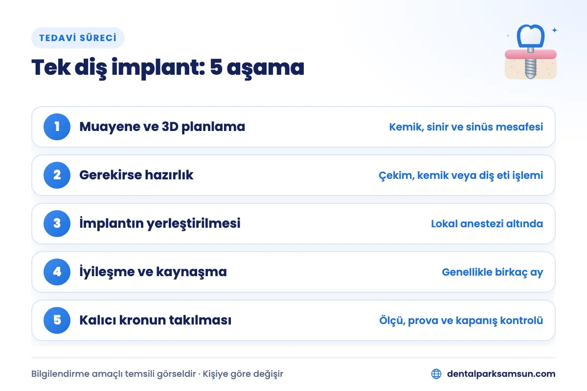 Samsun tek diş implant tedavisinin 5 aşaması: muayene ve 3D planlama, hazırlık, yerleştirme, iyileşme ve kron